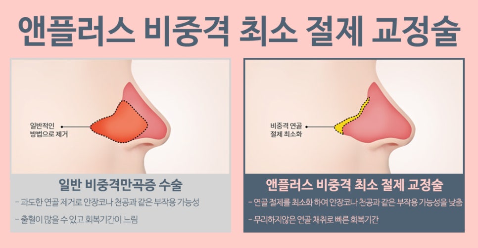 Septoplasty Surgery at N+ image 7