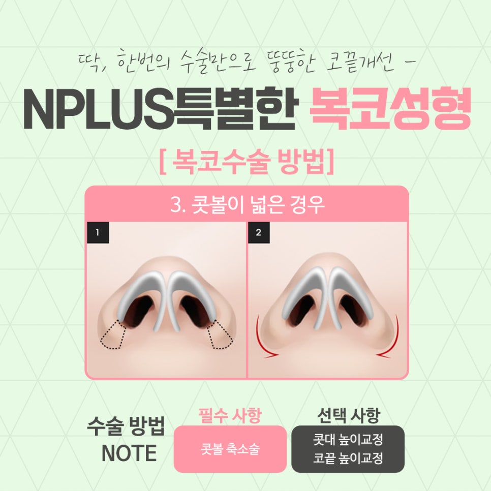 Before and After Bulbous Nose Surgery: Accurately Identifying the Cause image 9