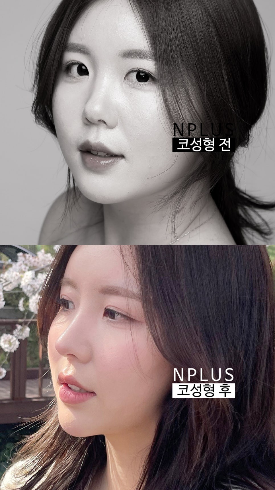 Short and Upturned Nose Shape Corrected with Autologous Rib Cartilage Nose Surgery at N Plus Clinic! image 16