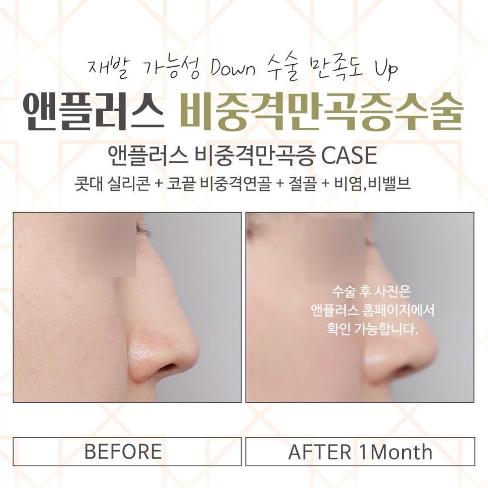 Septoplasty Surgery Review: Accurately Identifying the Cause image 16