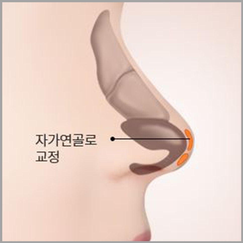 비염코성형? 어렵지 않아요. 관련 이미지 12
