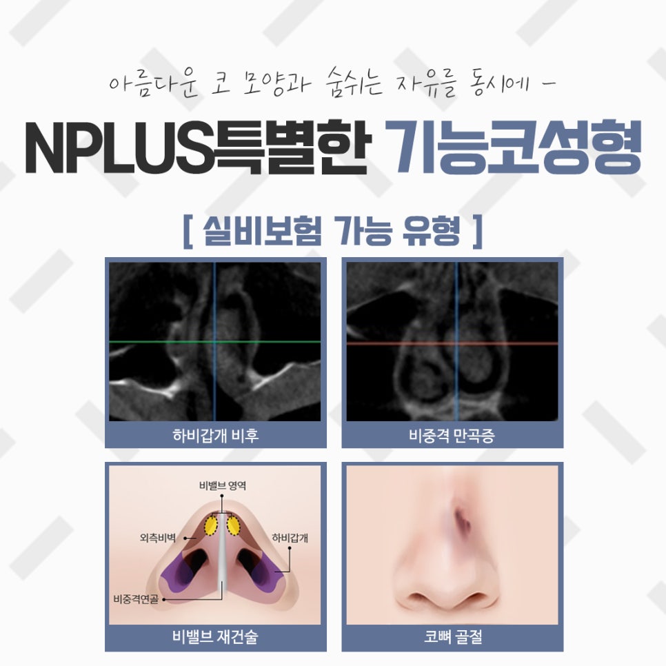 비염코성형실비 꼼꼼하게 체크하고 관련 이미지 5
