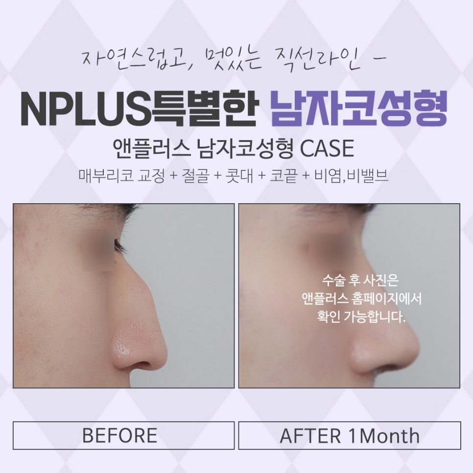 남자성형 자연스럽고 멋있게 관련 이미지 14