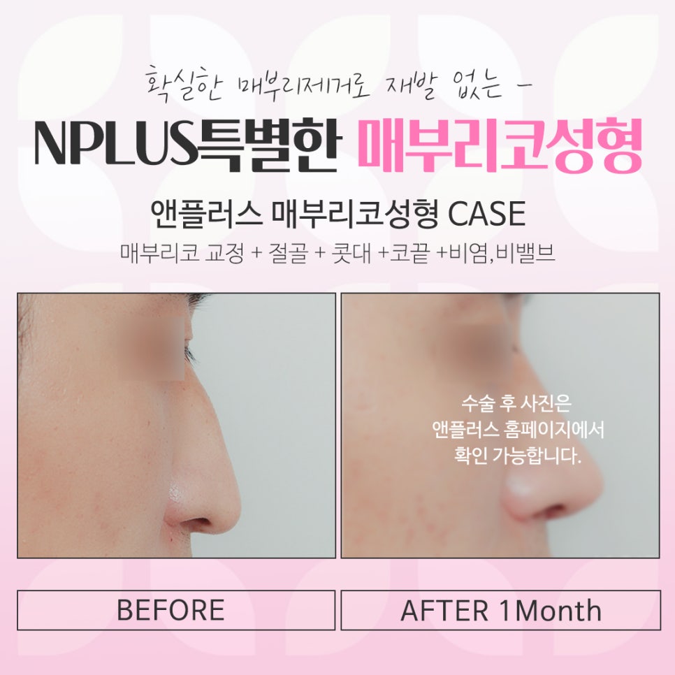 매부리코수술전후 비교를 한다면 관련 이미지 16