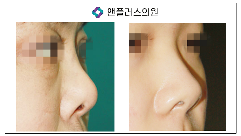 코재수술 1:1맞춤수술법 파헤치기 관련 이미지 5