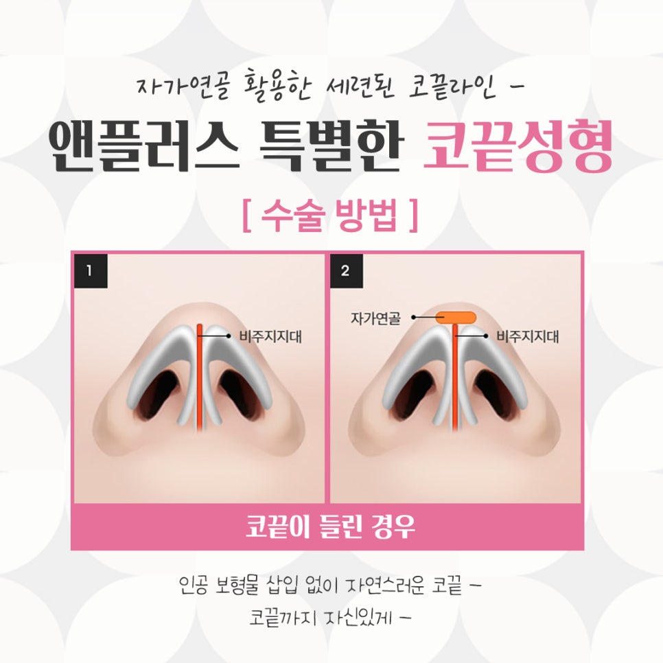 코끝수술후기의 다양함을 알아보고 관련 이미지 8