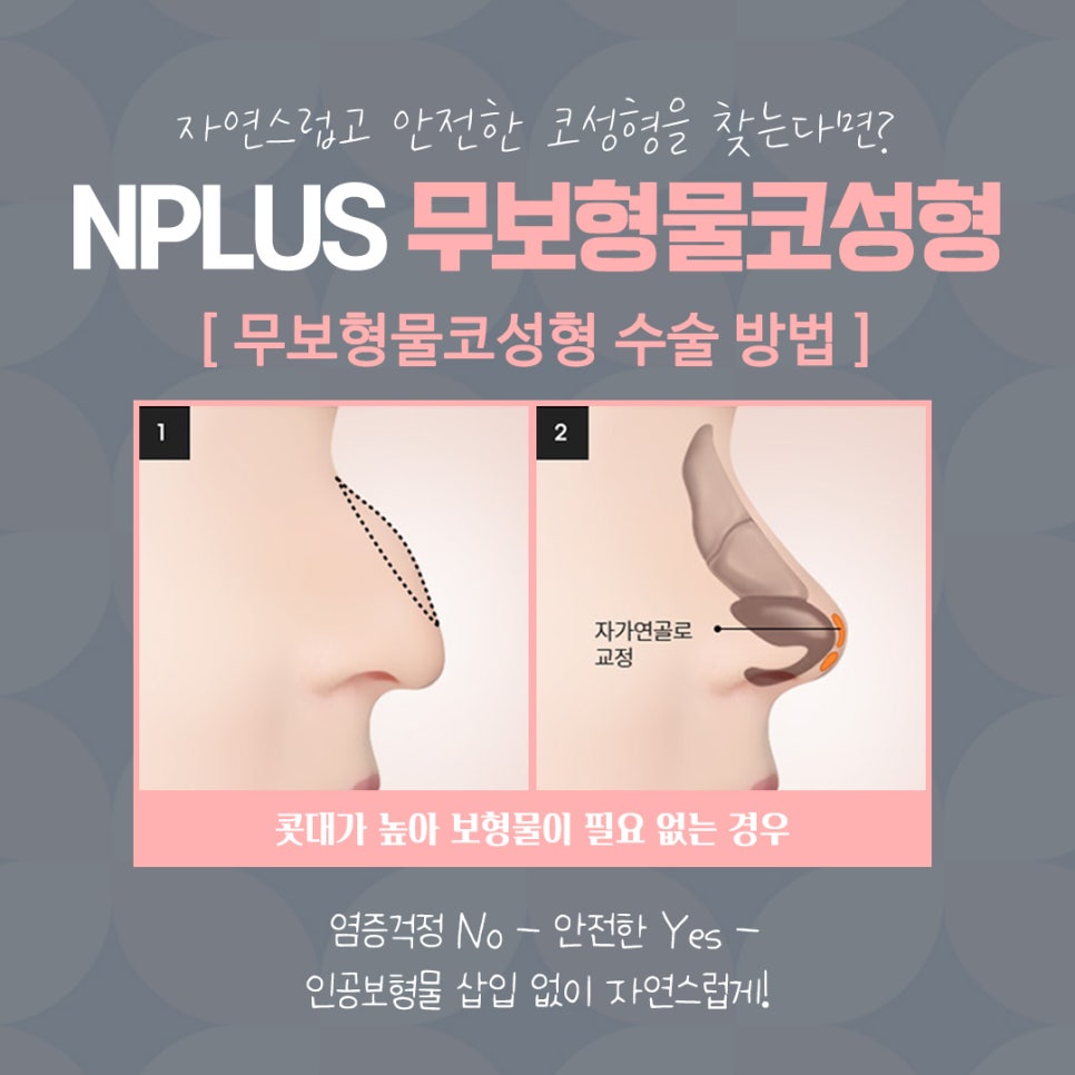 No-Implant Nose Surgery for a Natural Nose Line image 8
