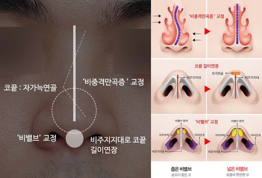 Natural and Satisfying Non-Implant Nose Surgery for Men image 6