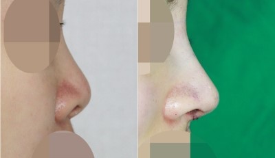 짧은코수술, 들창코수술 (콧대+코끝길이연장) 관련 이미지 1