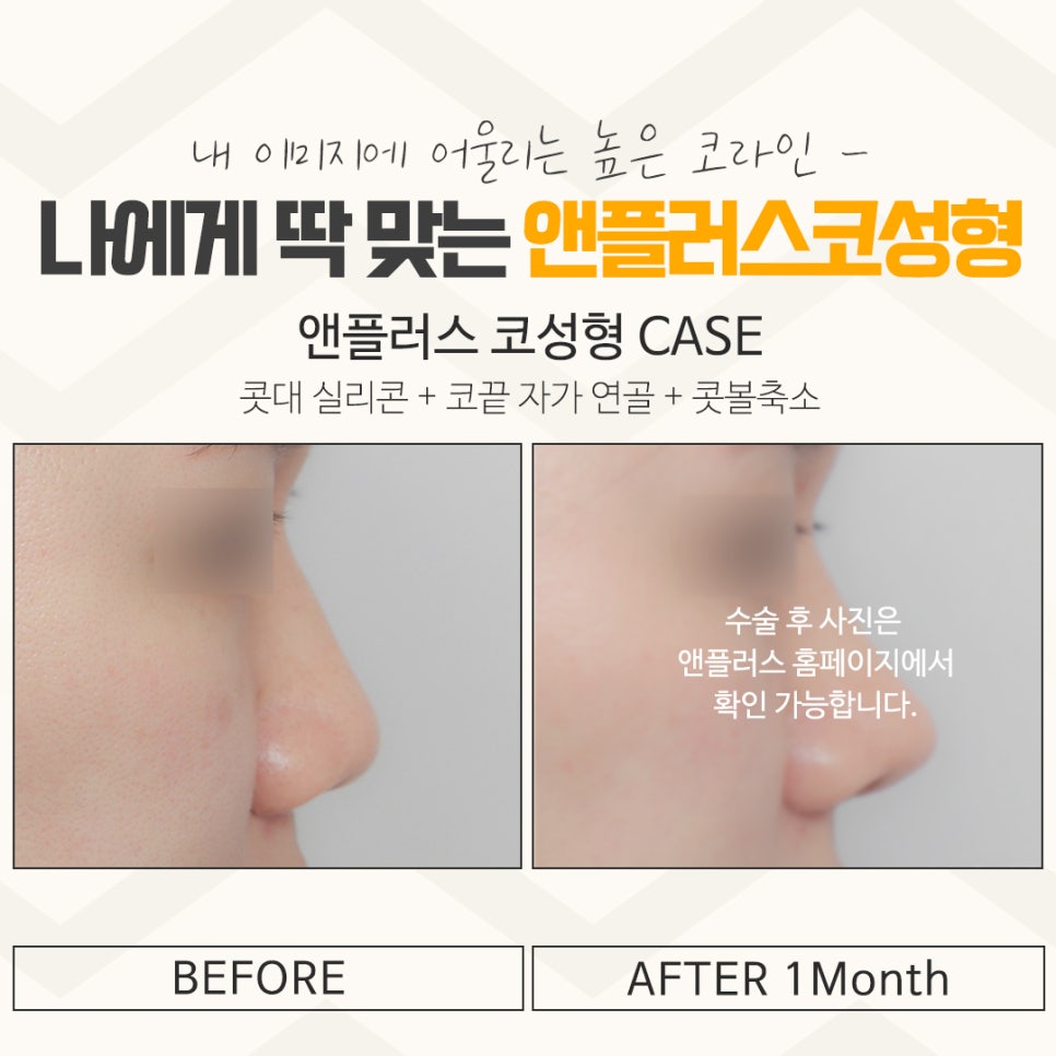 Understanding the Differences in Apgujeong Nose Surgery image 14