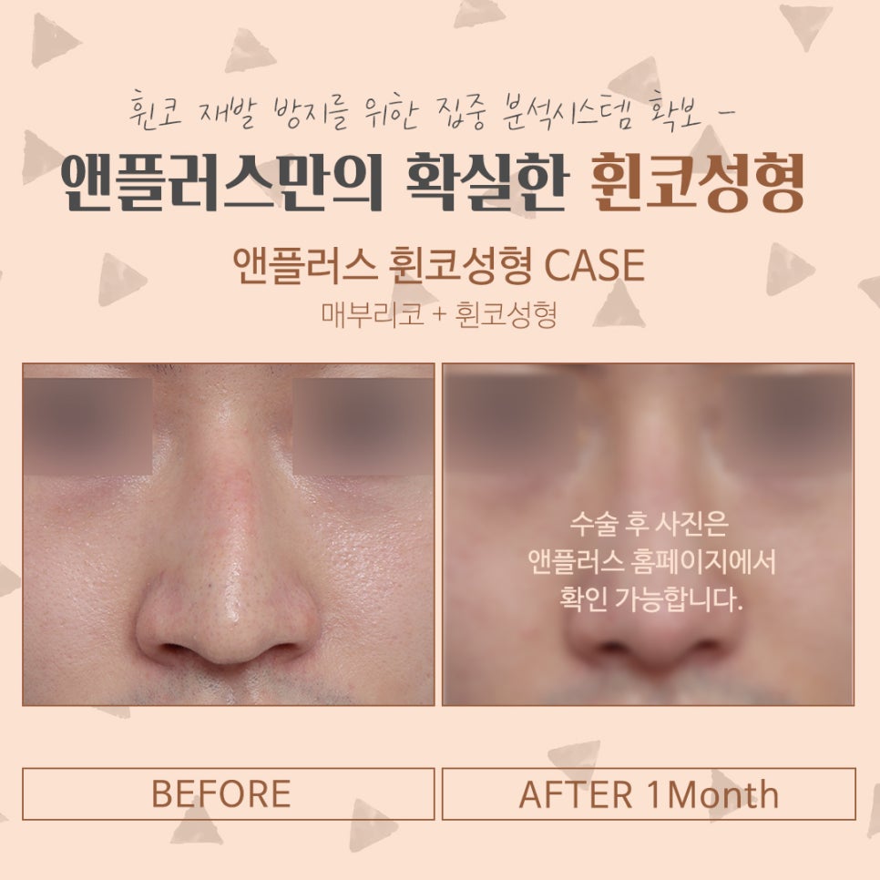 Crooked Nose Surgery Review, Including Functional Improvement image 11