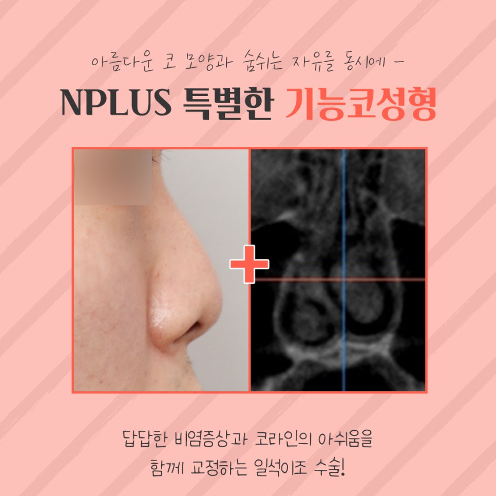 Female Rhinoplasty Review: A Line That Suits You image 6
