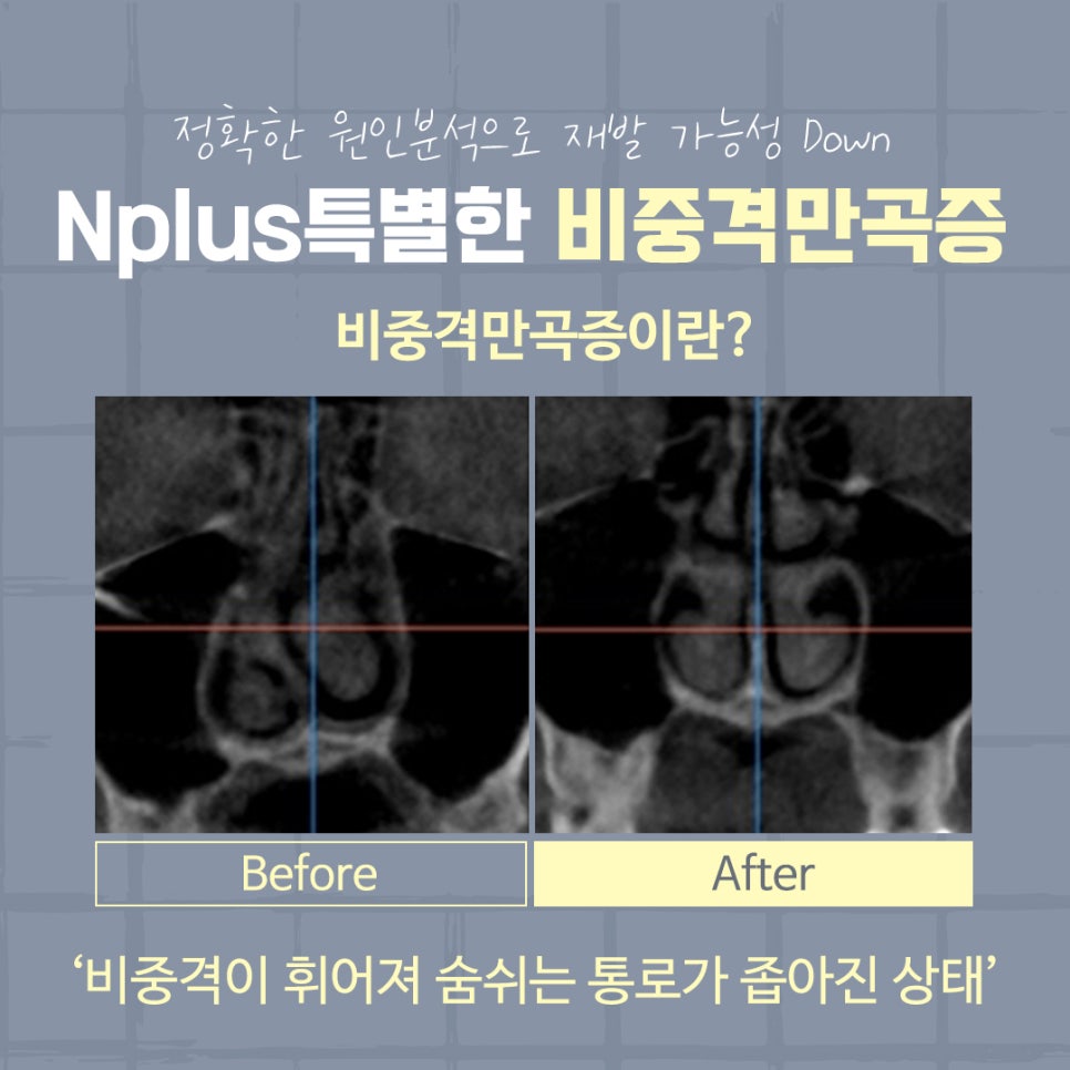 비중격만곡증수술 후기까지 확인하여 관련 이미지 6
