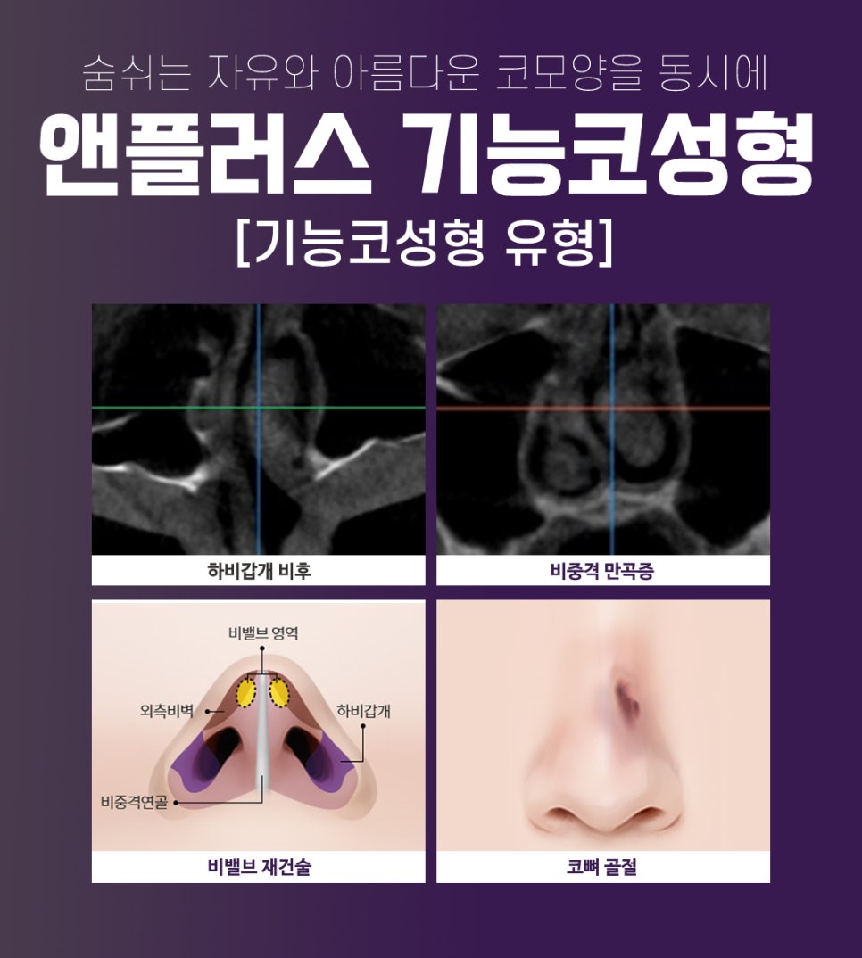 앤플러스에서 알려드리는 성형외과 기능코성형후기 관련 이미지 5