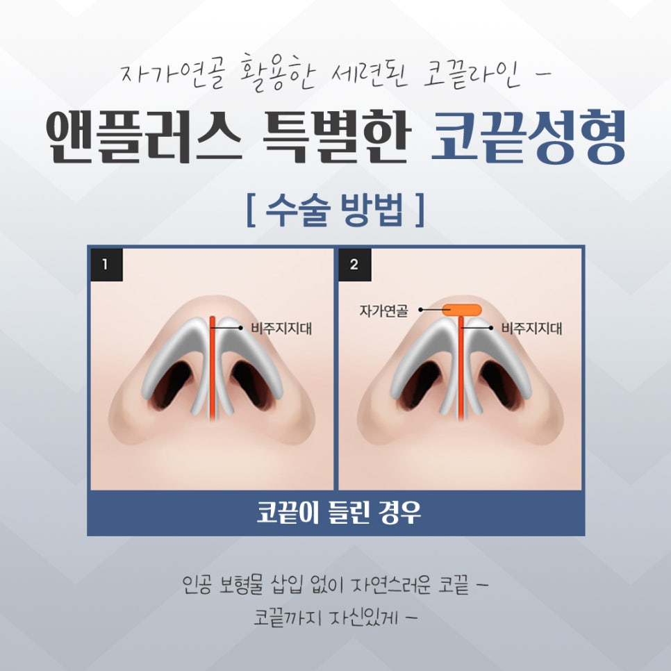 코끝수술후기에 대한 내용을 알아보고 관련 이미지 8