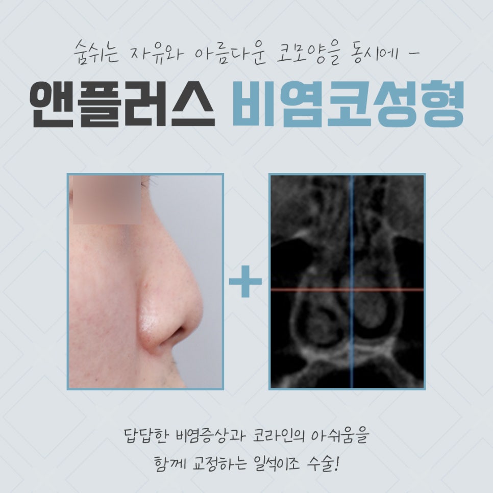비염코성형후기 원인을 자세하게 알아보고 관련 이미지 2