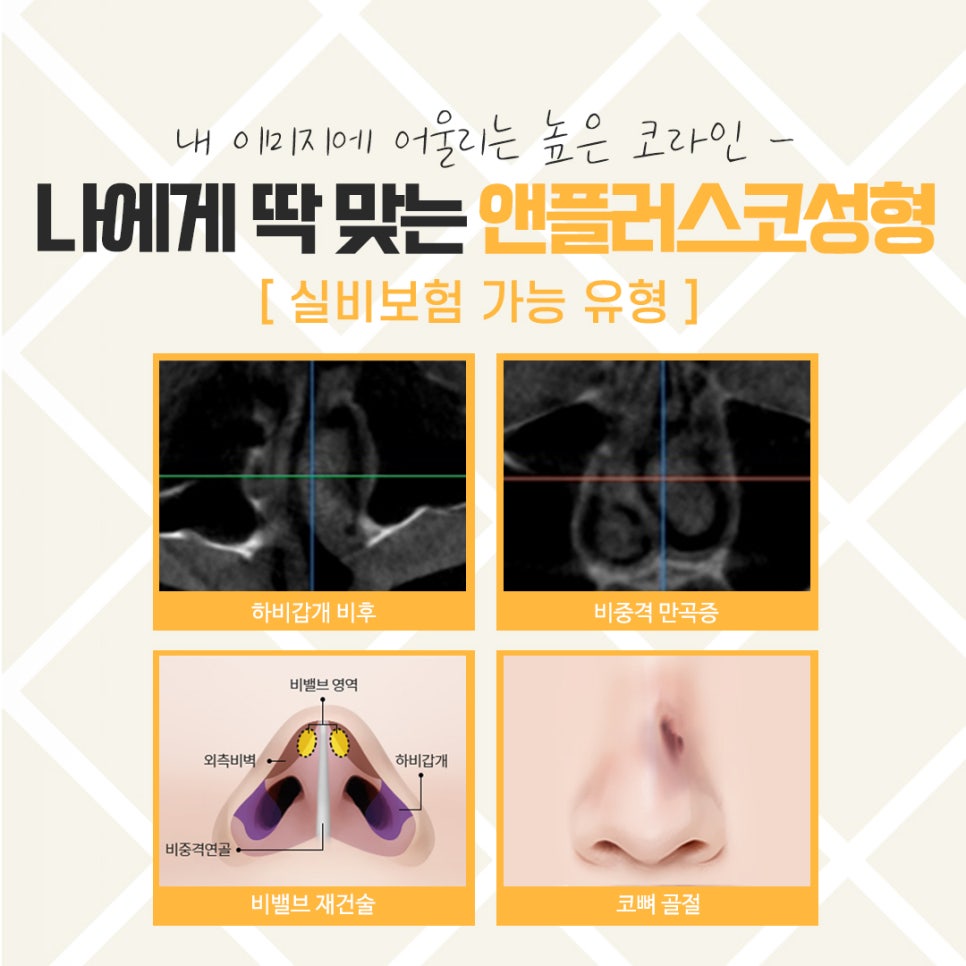 코뼈골절수술 자세하게 알아봐야 관련 이미지 8