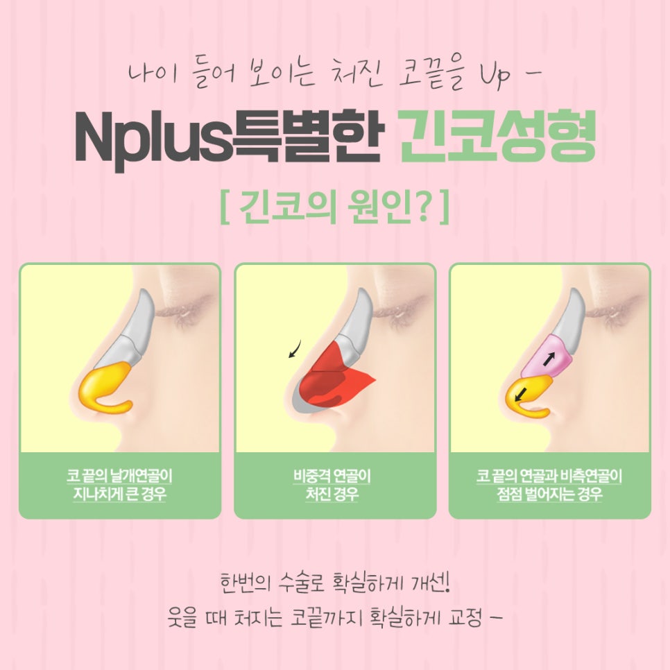 긴코성형으로 교정하고 동안 되자 관련 이미지 6