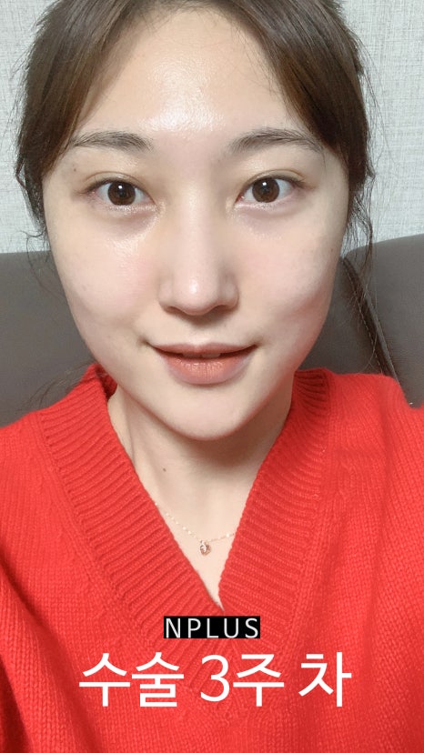 앤플러스에서 진행된 매부리코성형후기 관련 이미지 6