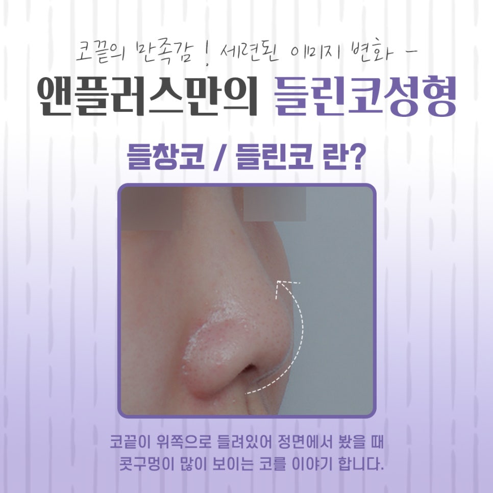 들린코성형 후기를 자세하게 알아보고 관련 이미지 4
