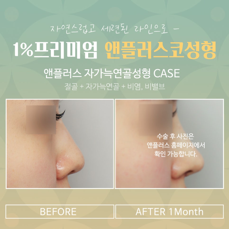 자가늑코성형 정확한 포인트를 파악하여 관련 이미지 14