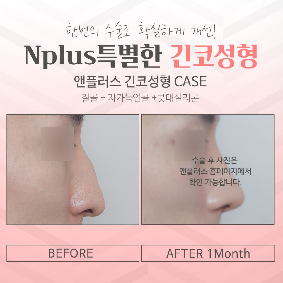 Learn More About Long Nose Surgery in Detail image 12