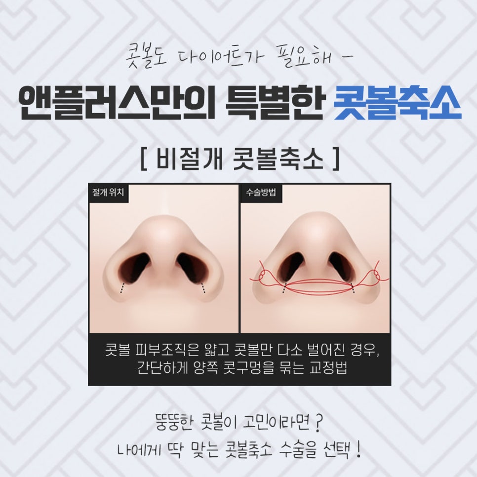콧볼축소수술 확실한 교정으로 관련 이미지 9