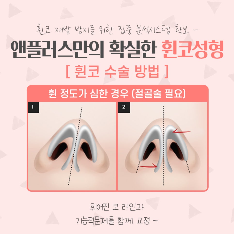휜코수술후기 정확한 진단을 통해 관련 이미지 8