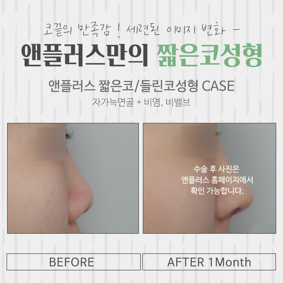 Learn About Short Nose Surgery Properly image 15