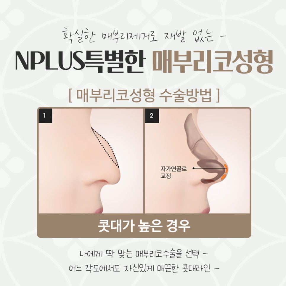Checking a Hump Nose Surgery Review in Various Ways image 8