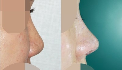 코재수술 앤플러스성형외과 : 실제 전후사진 관련 이미지 1