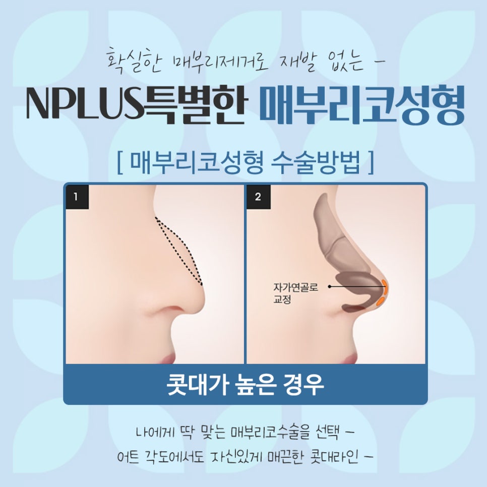 남자매부리코 원인을 정확하게 파악하고 관련 이미지 9