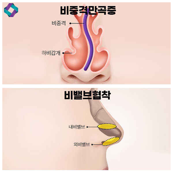 코수술 전후 비교, 앤플러스 매부리코에 대하여 관련 이미지 3