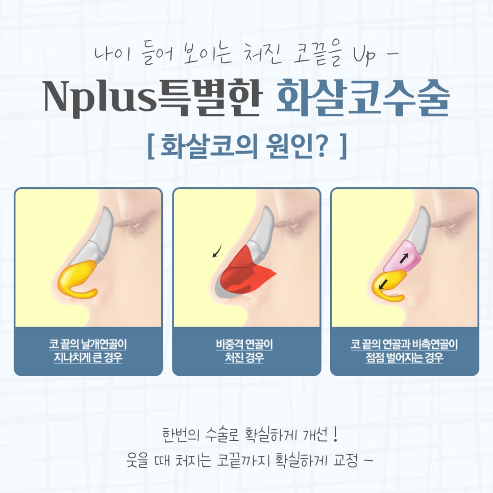 화살코수술 자세하게 알아보고 관련 이미지 6