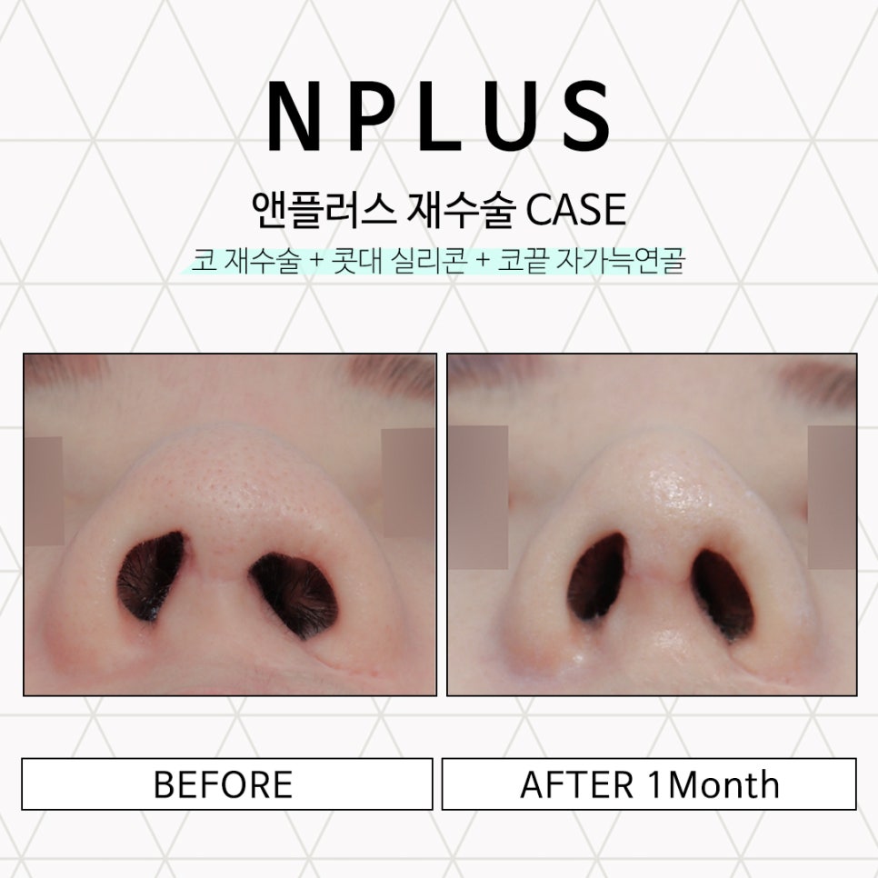 콧구멍비대칭 짝짝이에 대한 내용 정리! 관련 이미지 5