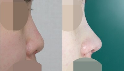 복코 + 낮은코 성형수술 전후사진 관련 이미지 1