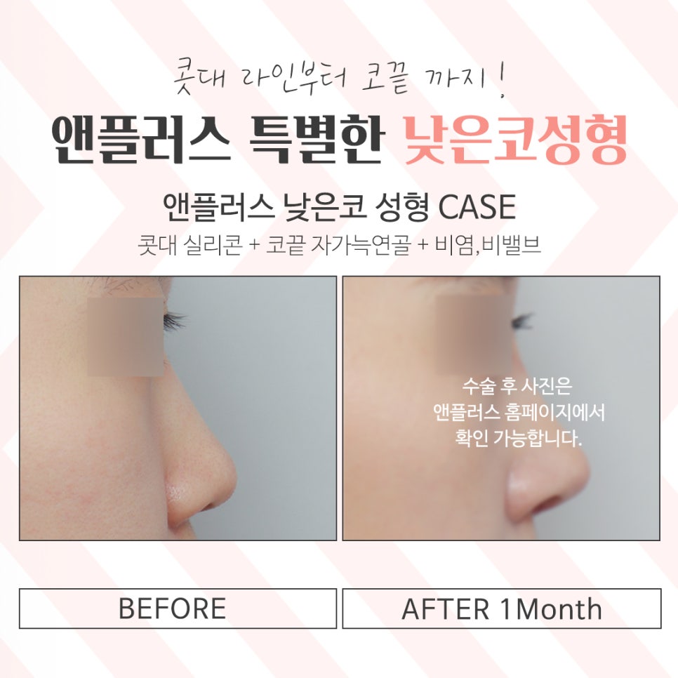 낮은코수술을 통해 날렵하고 세련된 이미지로 관련 이미지 2