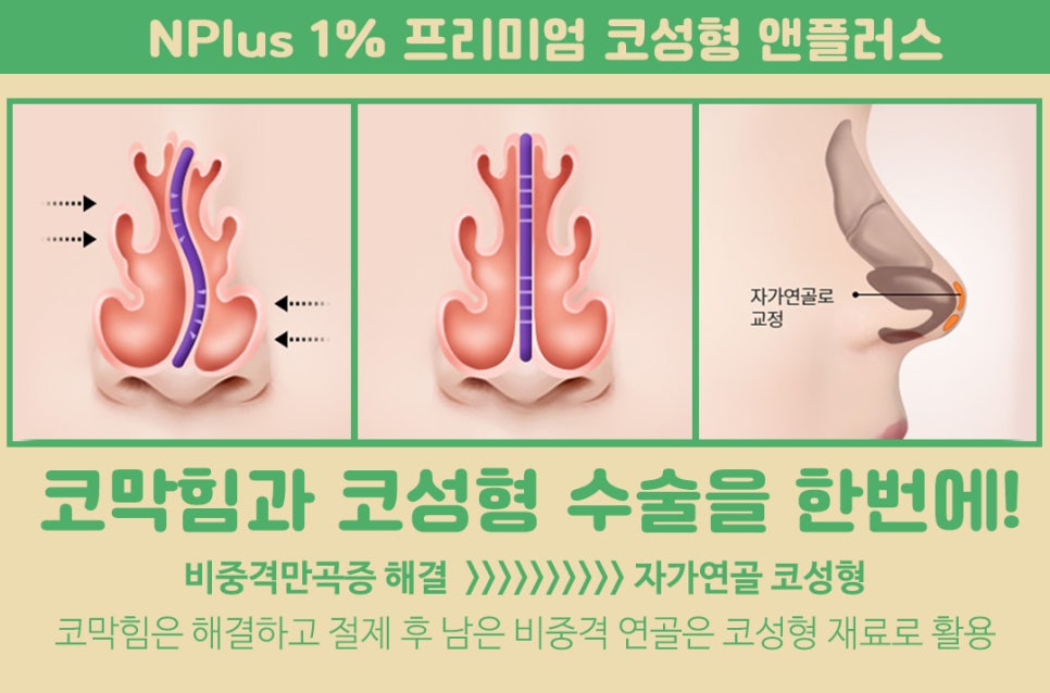 비염수술코성형 동시에 개선이 가능 관련 이미지 5