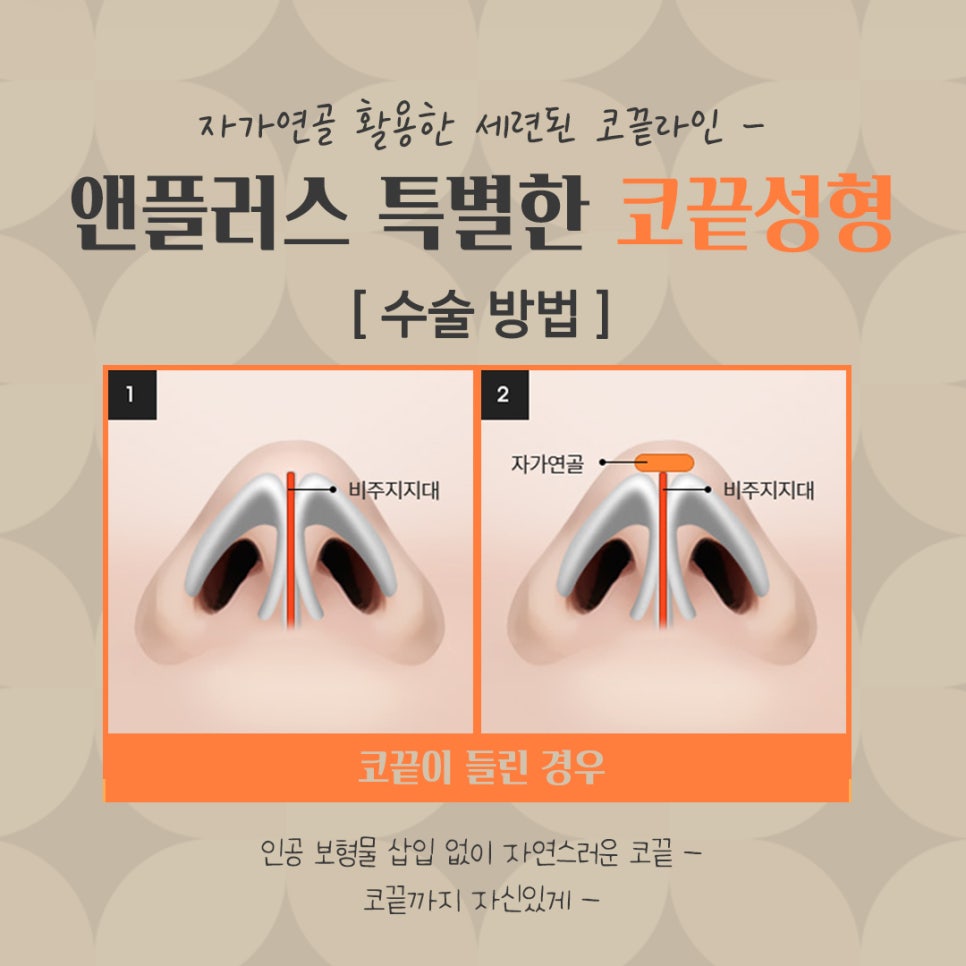 코끝수술후기 자가연골로 안전하게 관련 이미지 7