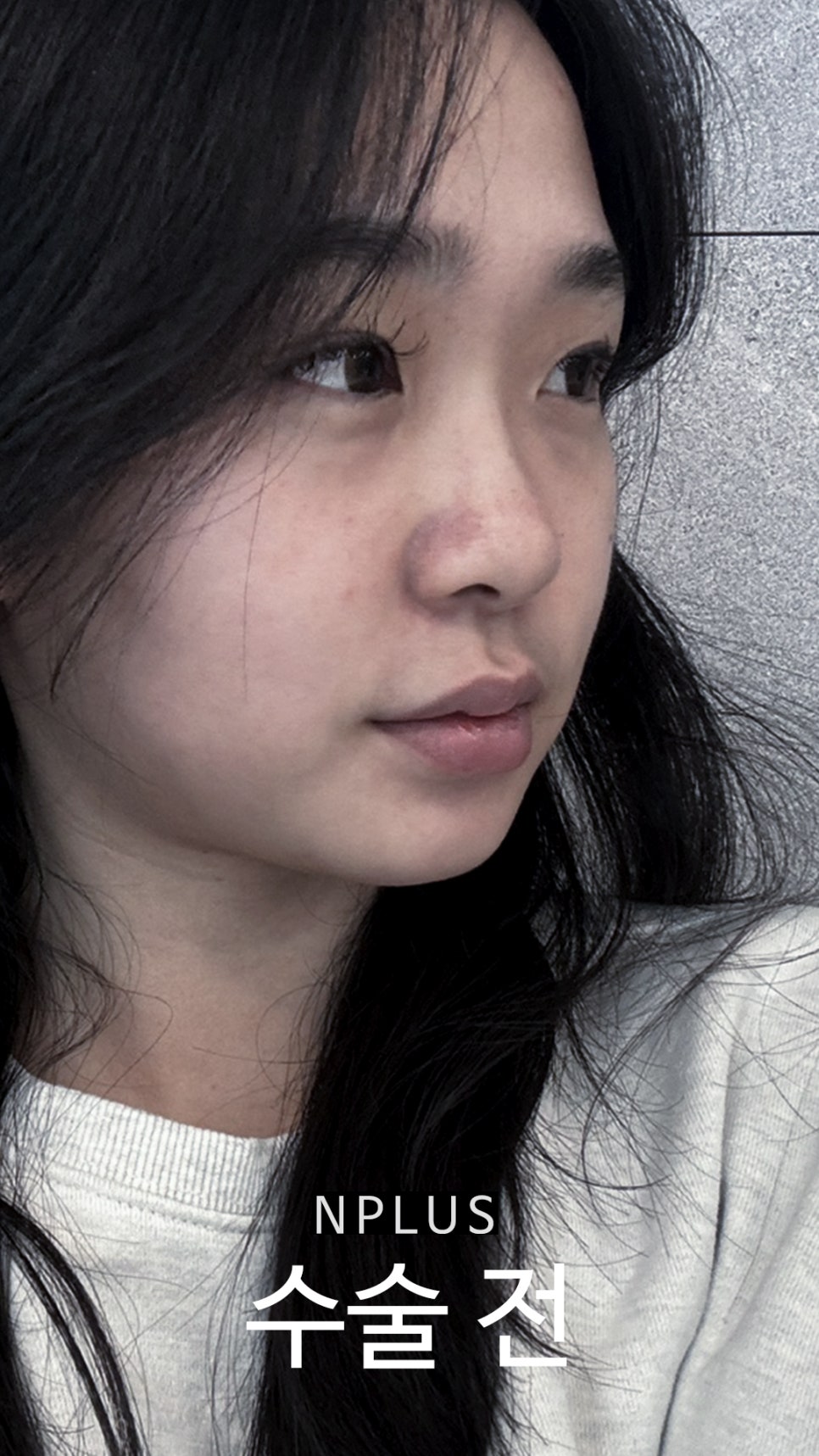 AN Plus Plastic Surgery Review: Silicone Nasal Bridge, Autologous Rib Cartilage Nasal Tip, Under-Eye Fat Repositioning, Fat Grafting image 3