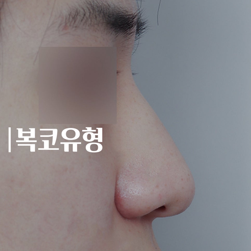성형하기 힘든 코유형 관련 이미지 7