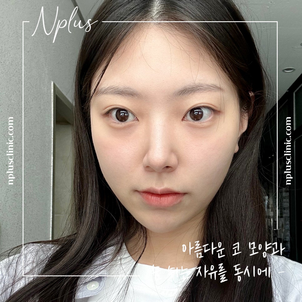 코성형후기 제대로 알아보고 관련 이미지 12