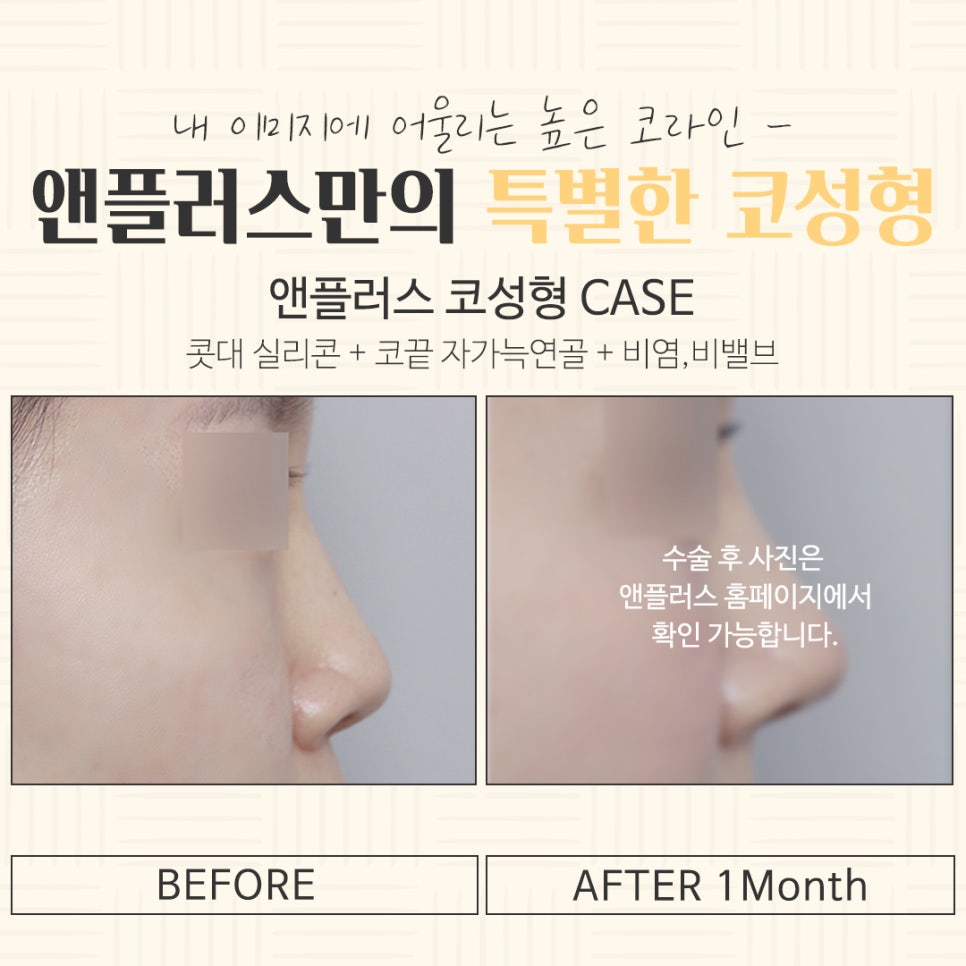 Looking into the differences in results at a rhinoplasty clinic image 16