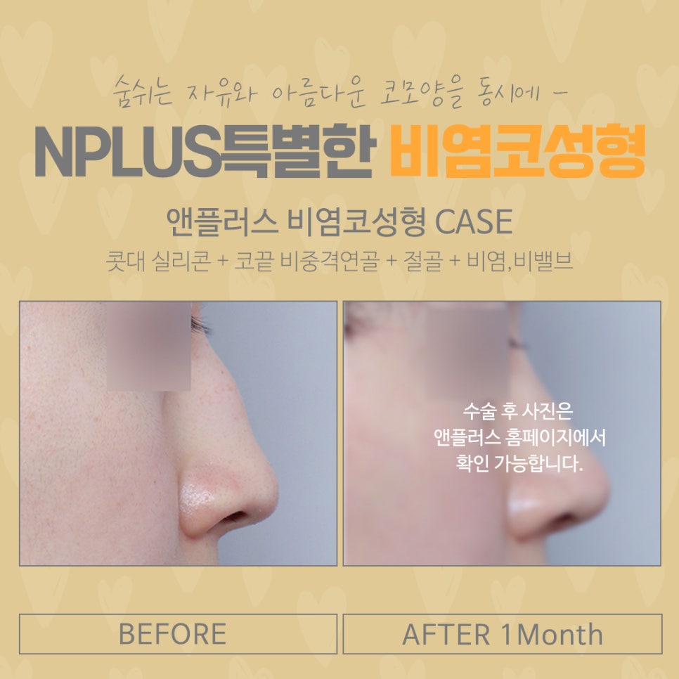 코막힘원인 정확하게 파악하는 것이 중요 관련 이미지 14
