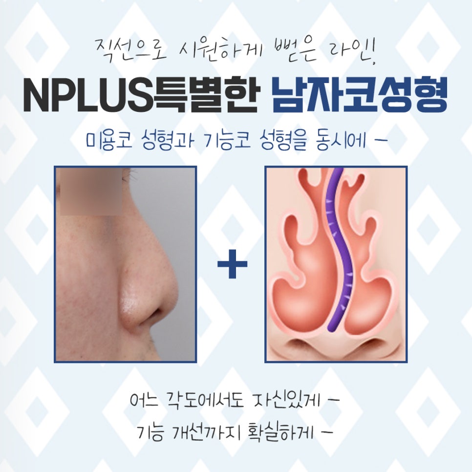 남자비염코성형 자세하게 알아보고 결정 관련 이미지 5