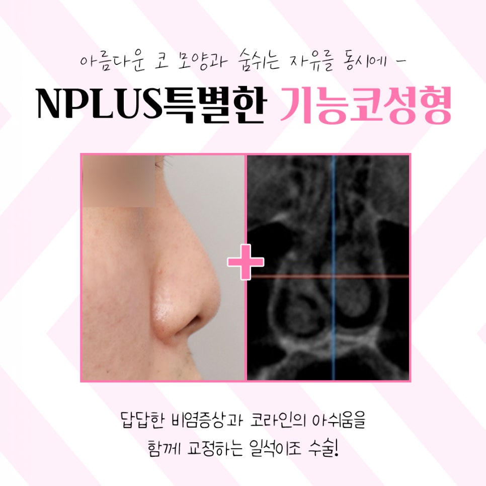 앤플러스 기능코수술후기 선택의 중요성 관련 이미지 3