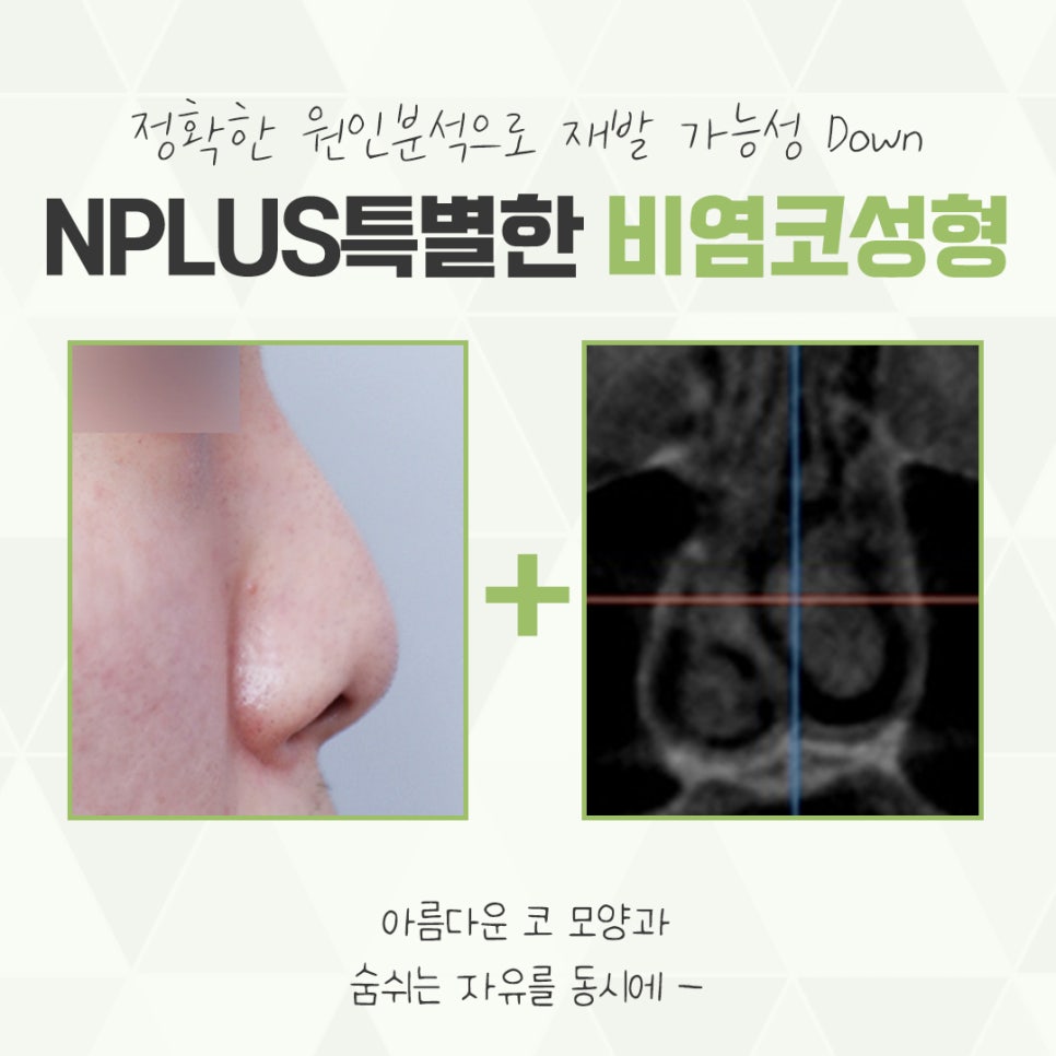 비염수술코성형 다양한 요인을 확인하여 관련 이미지 3