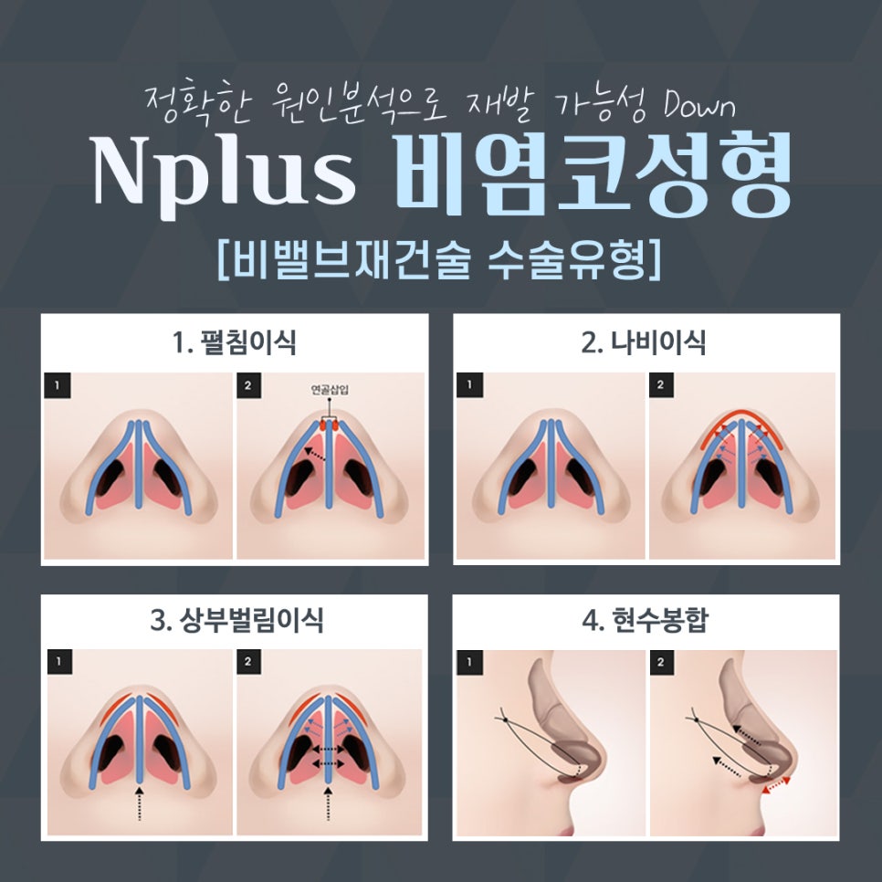 비염수술 방법과 후기까지 관련 이미지 9