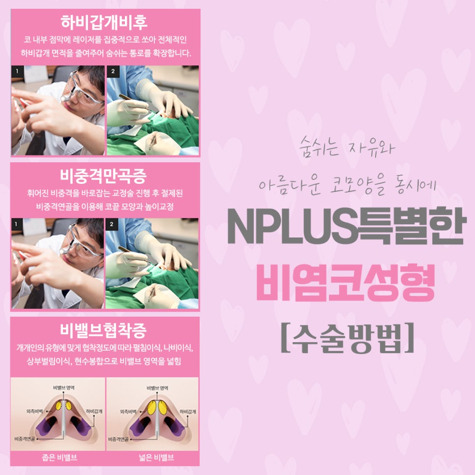 비염코수술 원인을 정확하게 파악하고 관련 이미지 8
