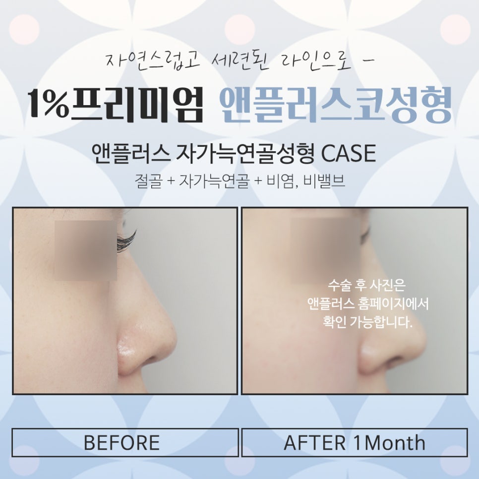 Reviewing and Deciding on Self-Rib Nose Surgery Reviews image 14